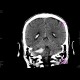 Intraparenchymal hemorrhage into cerebellum: CT - Computed tomography